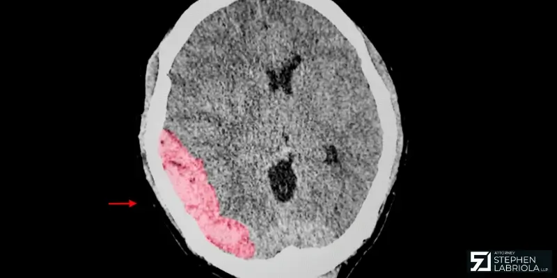 Top-rated Jonesboro Traumatic Brain Injury Lawyer